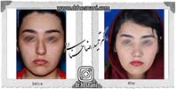 عمل بینی شماره 873