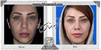 عمل بینی شماره 875