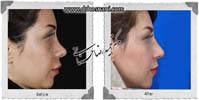 عمل بینی شماره 876