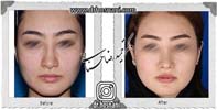 عمل بینی شماره 877