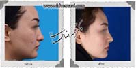 عمل بینی شماره 878