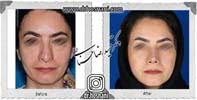 عمل بینی شماره 880