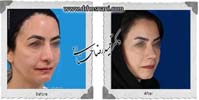 عمل بینی شماره 881