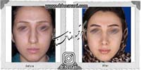 عمل بینی شماره 885