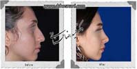 عمل بینی شماره 886