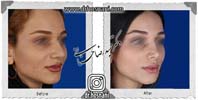  جراحی بینی -890