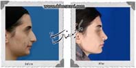 عمل بینی شماره 893غضروفی (استخوانی)