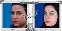 عمل بینی شماره 895غضروفی با پوست ضخیم