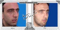 عمل بینی شماره 903