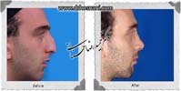  جراحی بینی -904