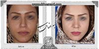 عمل بینی شماره 905غضروفی با پوست ضخیم