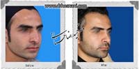 عمل بینی شماره 910