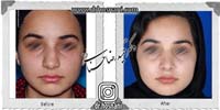 عمل بینی شماره 911