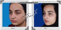 عمل بینی شماره 912