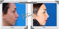 عمل بینی شماره 914