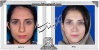 عمل بینی شماره 915