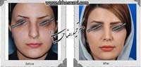  جراحی بینی -919
