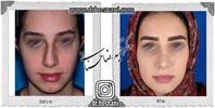 عمل بینی شماره 923غضروفی با پوست ضخیم