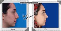  جراحی بینی -924