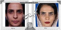  جراحی بینی -925