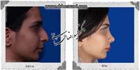  جراحی بینی -926