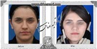عمل بینی شماره 927غضروفی (استخوانی)