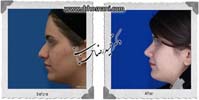عمل بینی شماره 928غضروفی (استخوانی)