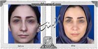 عمل بینی شماره 929غضروفی با پوست ضخیم