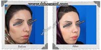 عمل بینی شماره 93