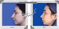 عمل بینی شماره 930غضروفی با پوست ضخیم