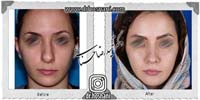 عمل بینی شماره 931غضروفی (استخوانی)