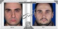 عمل بینی شماره 933غضروفی (استخوانی)