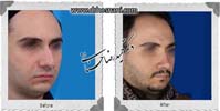 عمل بینی شماره 934