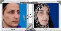 عمل بینی شماره 941