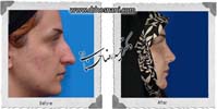 عمل بینی شماره 942