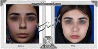 عمل بینی شماره 945