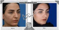 عمل بینی شماره 947