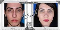 عمل بینی شماره 951
