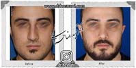 عمل بینی شماره 953