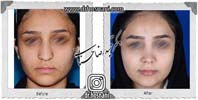 عمل بینی شماره 955