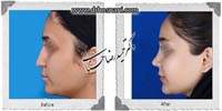 عمل بینی شماره 956