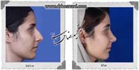 عمل بینی شماره 958