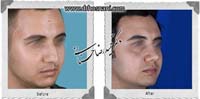 عمل بینی شماره 962