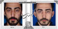 عمل بینی شماره 963