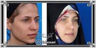 عمل بینی شماره 966