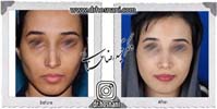 عمل بینی شماره 967