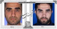عمل بینی شماره 971