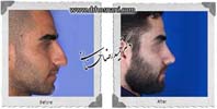 عمل بینی شماره 972