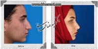 عمل بینی شماره 974