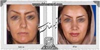 عمل بینی شماره 975